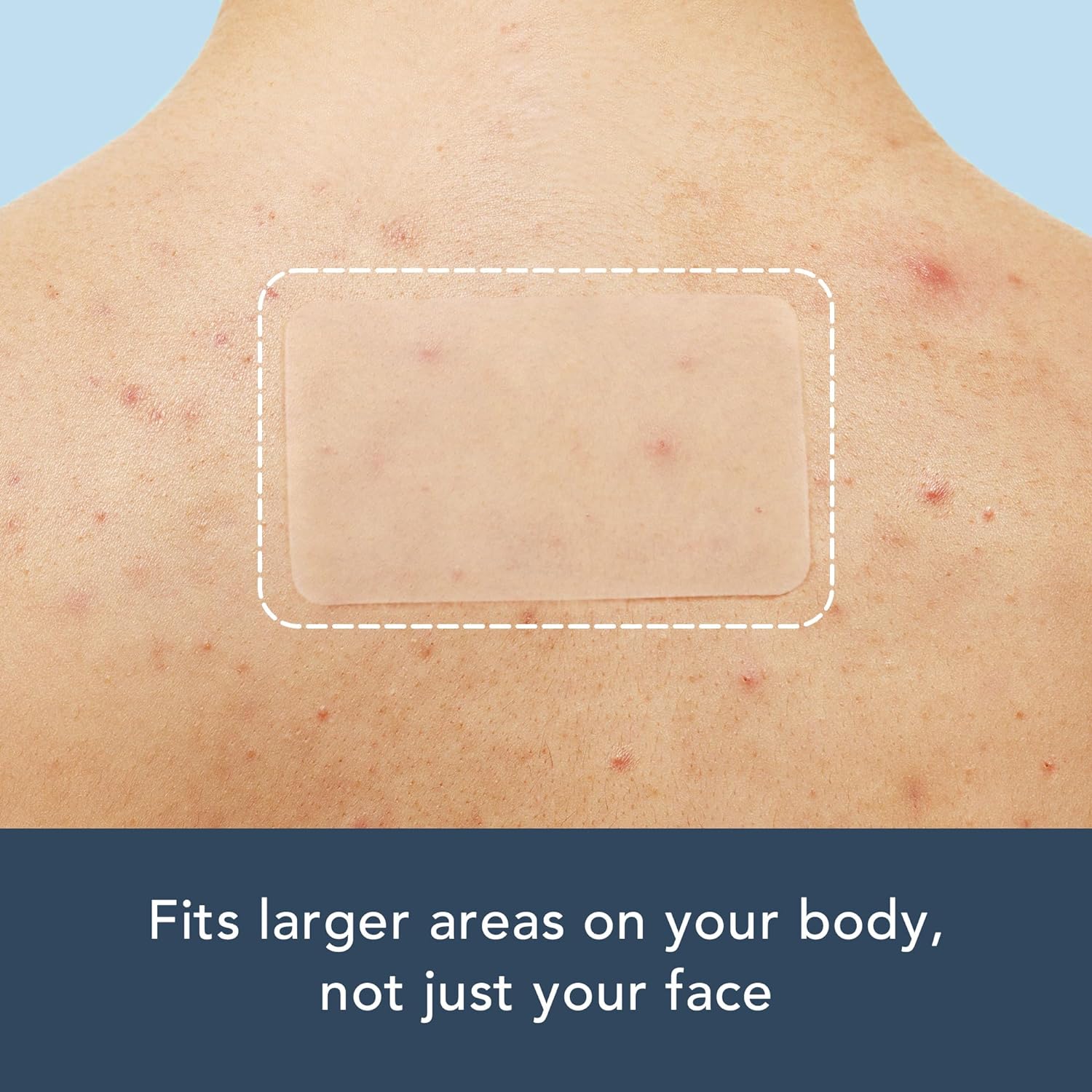 15 große, lange Akne-Pflaster. – Face Oil Bewertung und Preis