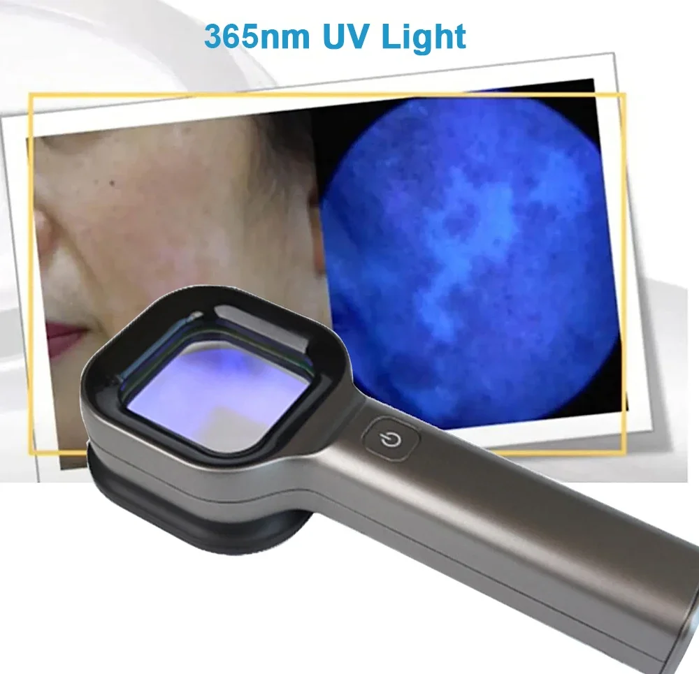 Woods Lamp Hautanalysator Haut – Skincare Glowing Bewertung und Preis